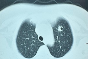 上海新增1例本土无症状感染者,这名患者的病情严重吗？